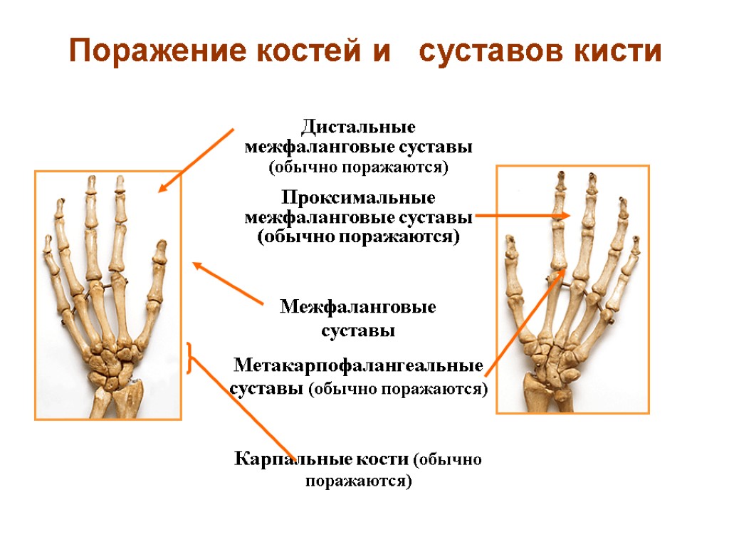 Поражение костей и суставов кисти